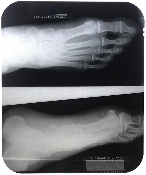 Elvis Presleys X-Ray of His Right Foot from the Day After the February 18, 1973 On-Stage "Attack" at the Las Vegas Hilton!